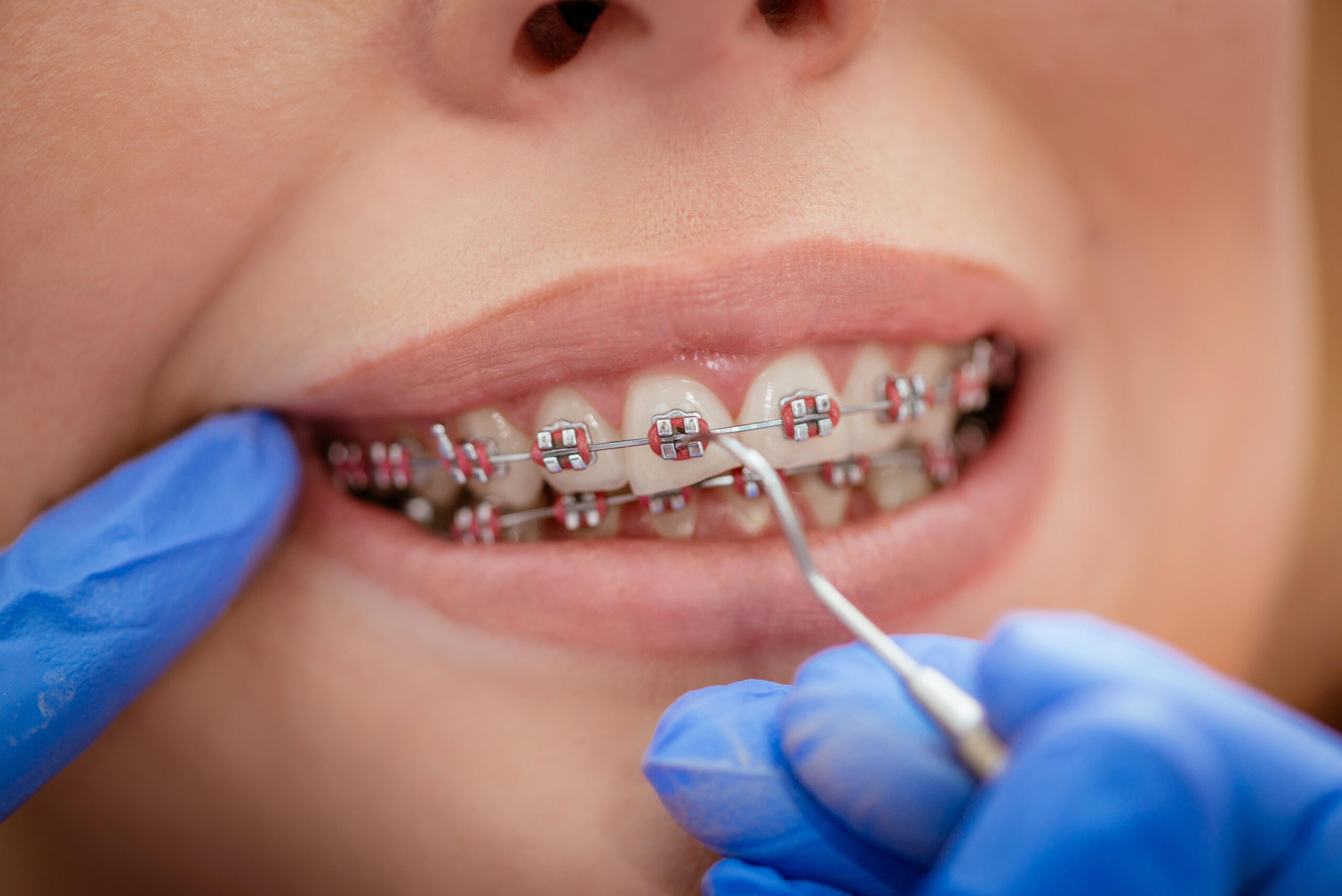 Damon Braces vs Traditional Braces: Which is Better?