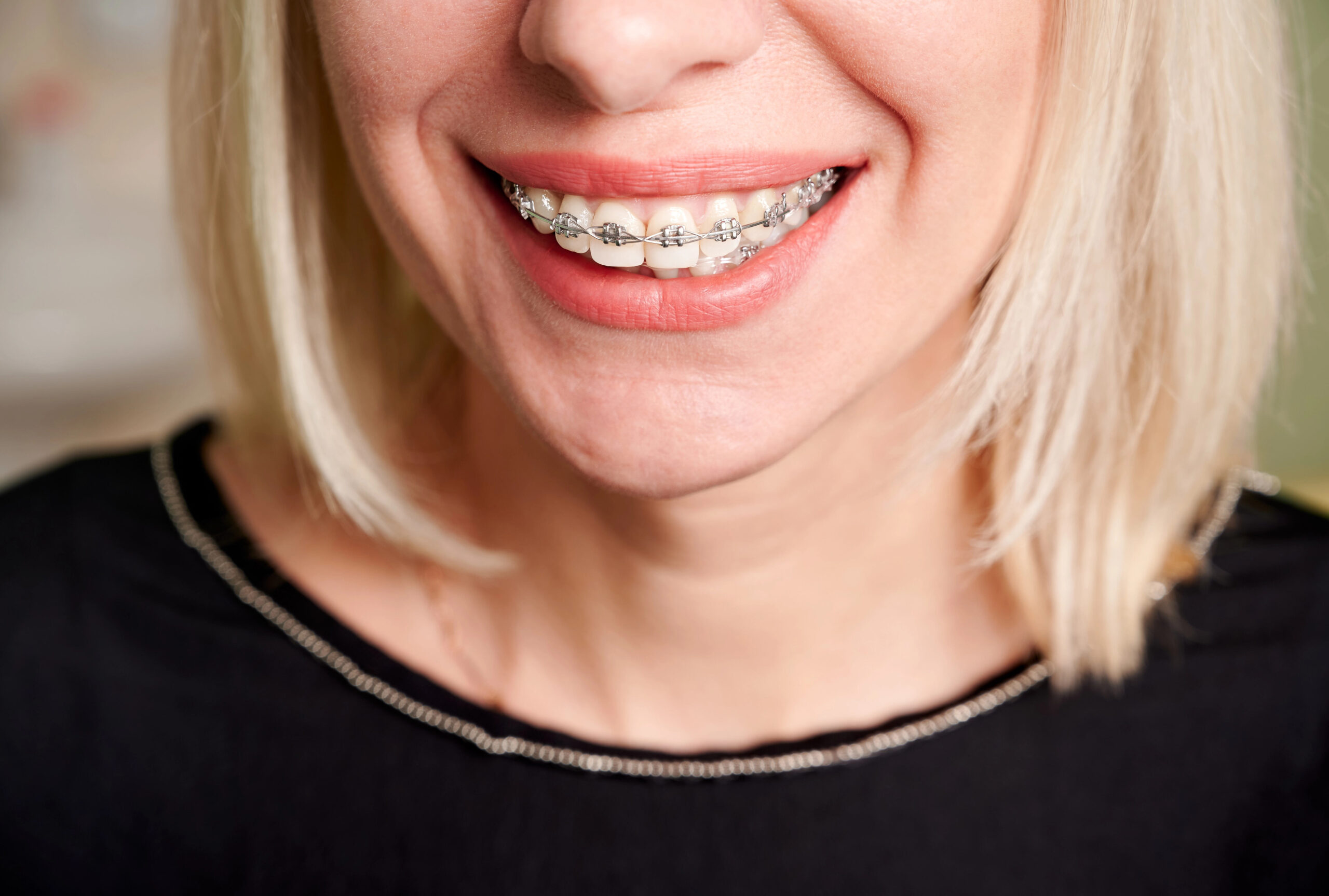 Fast Braces vs Traditional Braces: Speed or Comfort?