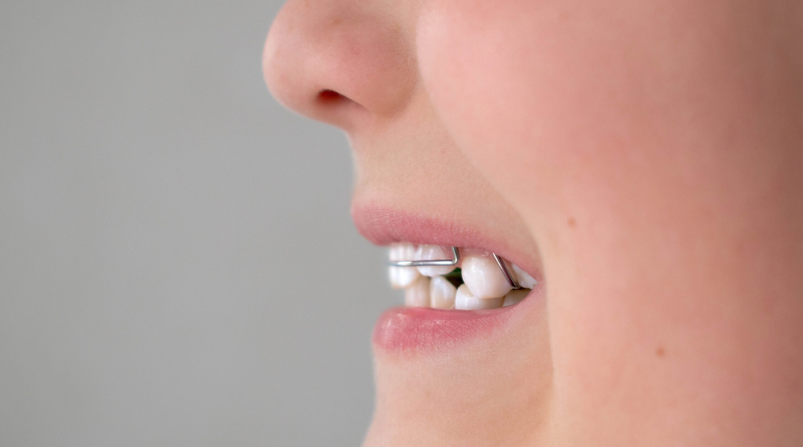 Invisalign for Deep Bite: Correct Your Smile Painlessly