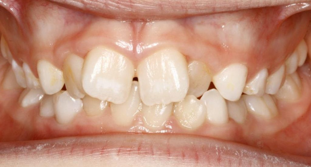 Invisalign for Crossbite: A Simple, Clear Solution